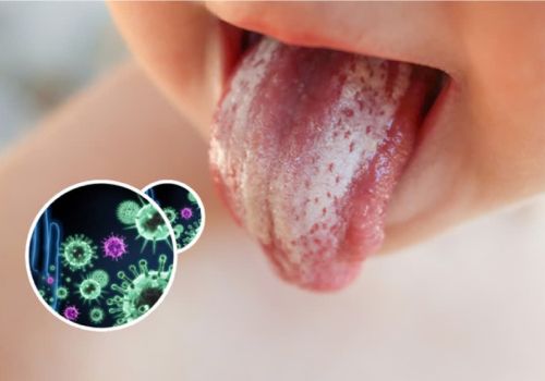 3 NGUYÊN TẮC VÀNG ĐỂ CON KHÔNG TÁI PHÁT NẤM MIỆNG